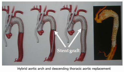 Stent graft